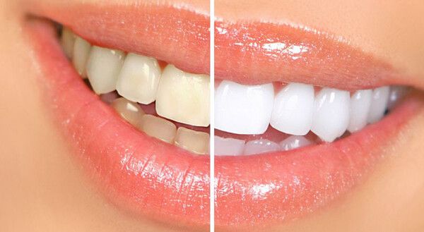 Nên dùng bột tẩy trắng răng đúng cách và đúng liều lượng